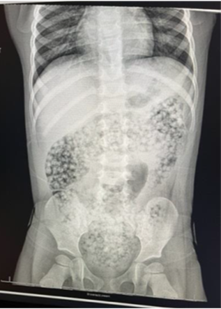 X-Ray scan showing water beads in a child’s intestines. Water beads are associated with thousands of emergency-department visits every year.